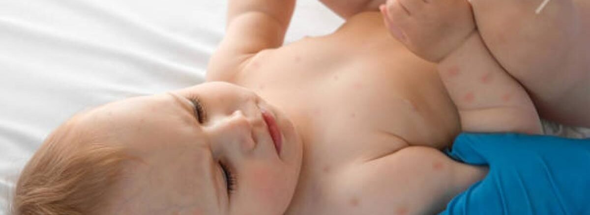 الأمراض الجلدية عند الأطفال