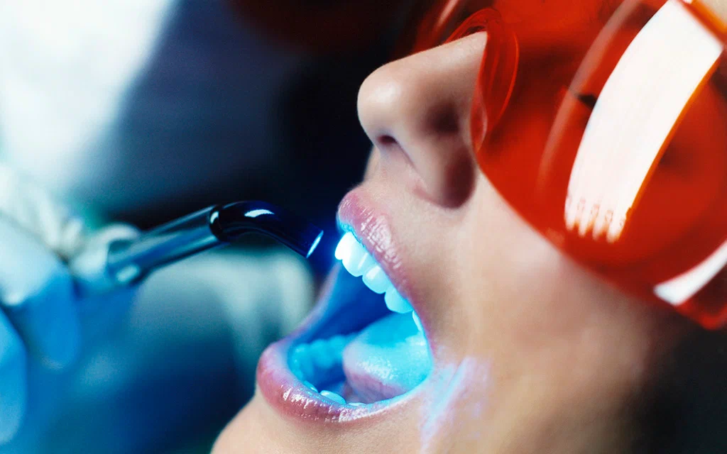 تبييض الأسنان بالليزر