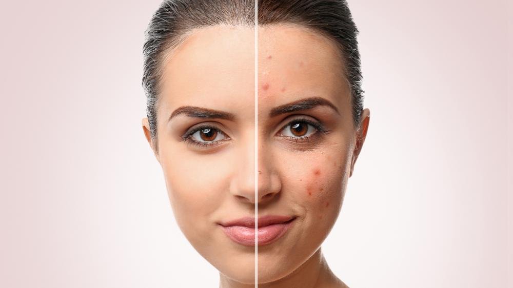 Laser treatment for skin diseases