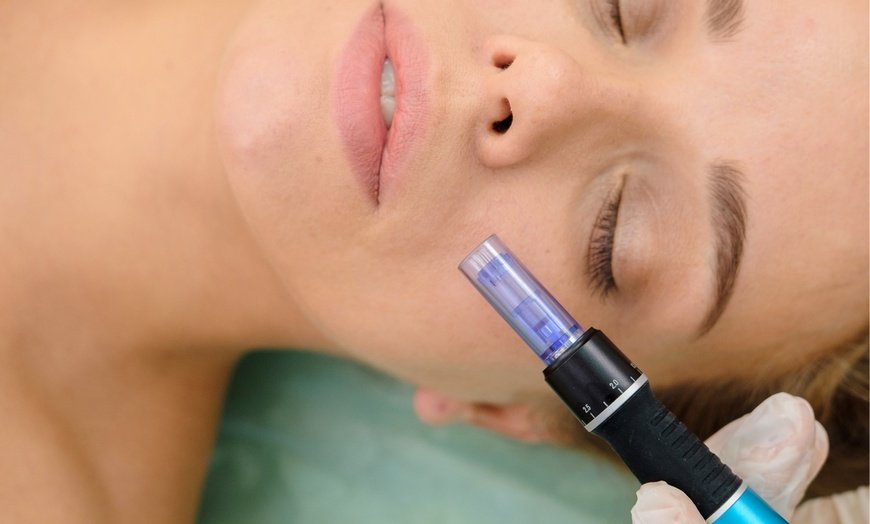 Dermapen Treatment