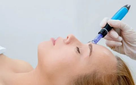 Dermapen Treatment: 10 Benefits & How Does It Work?