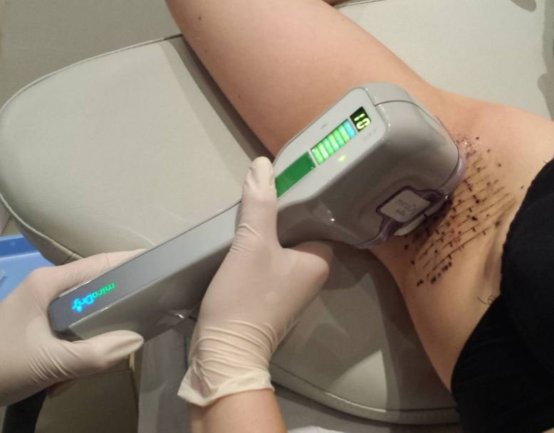 miradry treatment advantages