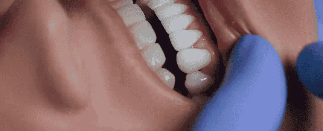 types of dental veneers