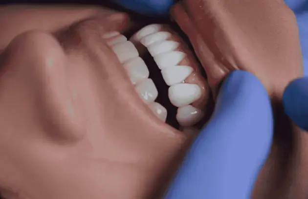 types of dental veneers