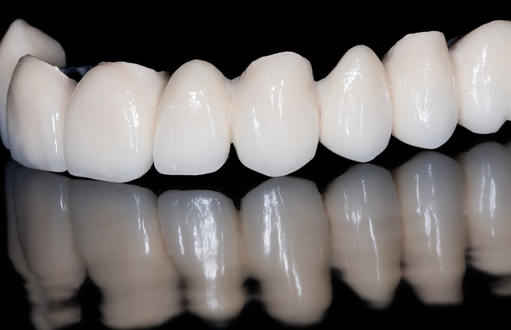 Zirconium veneers