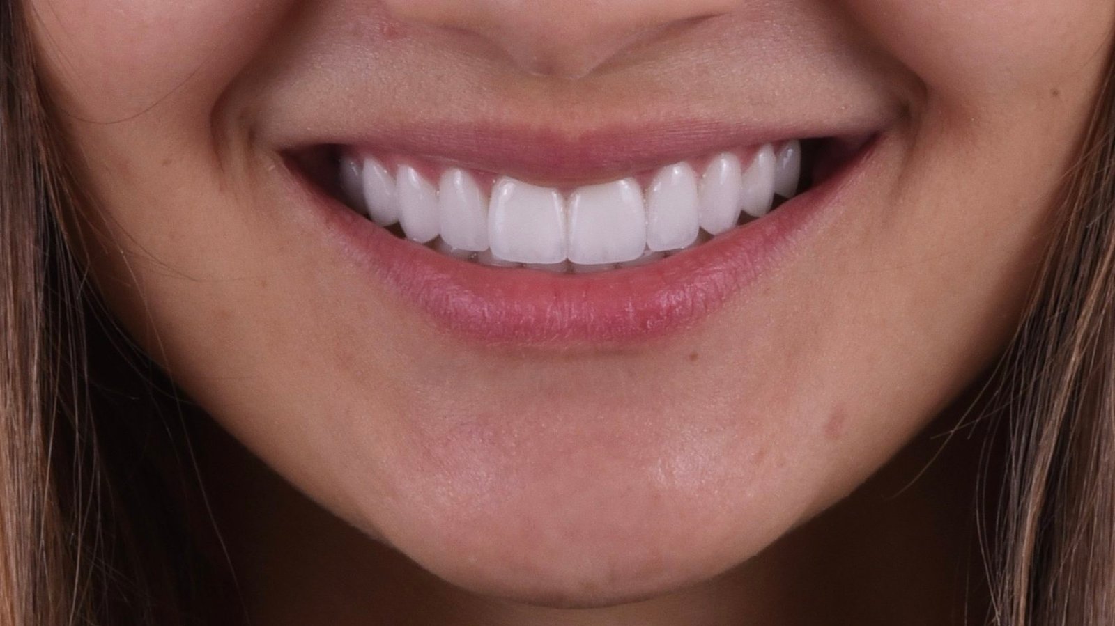 Zirconium veneers