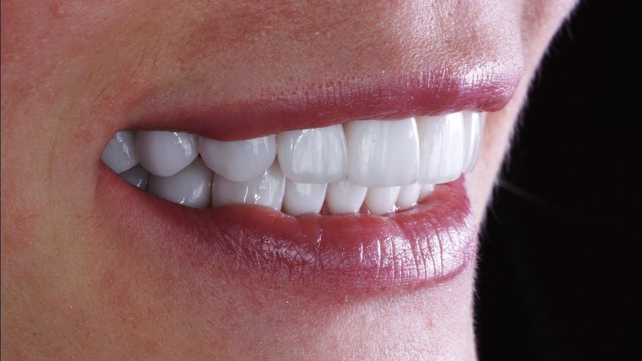 Zirconium veneers